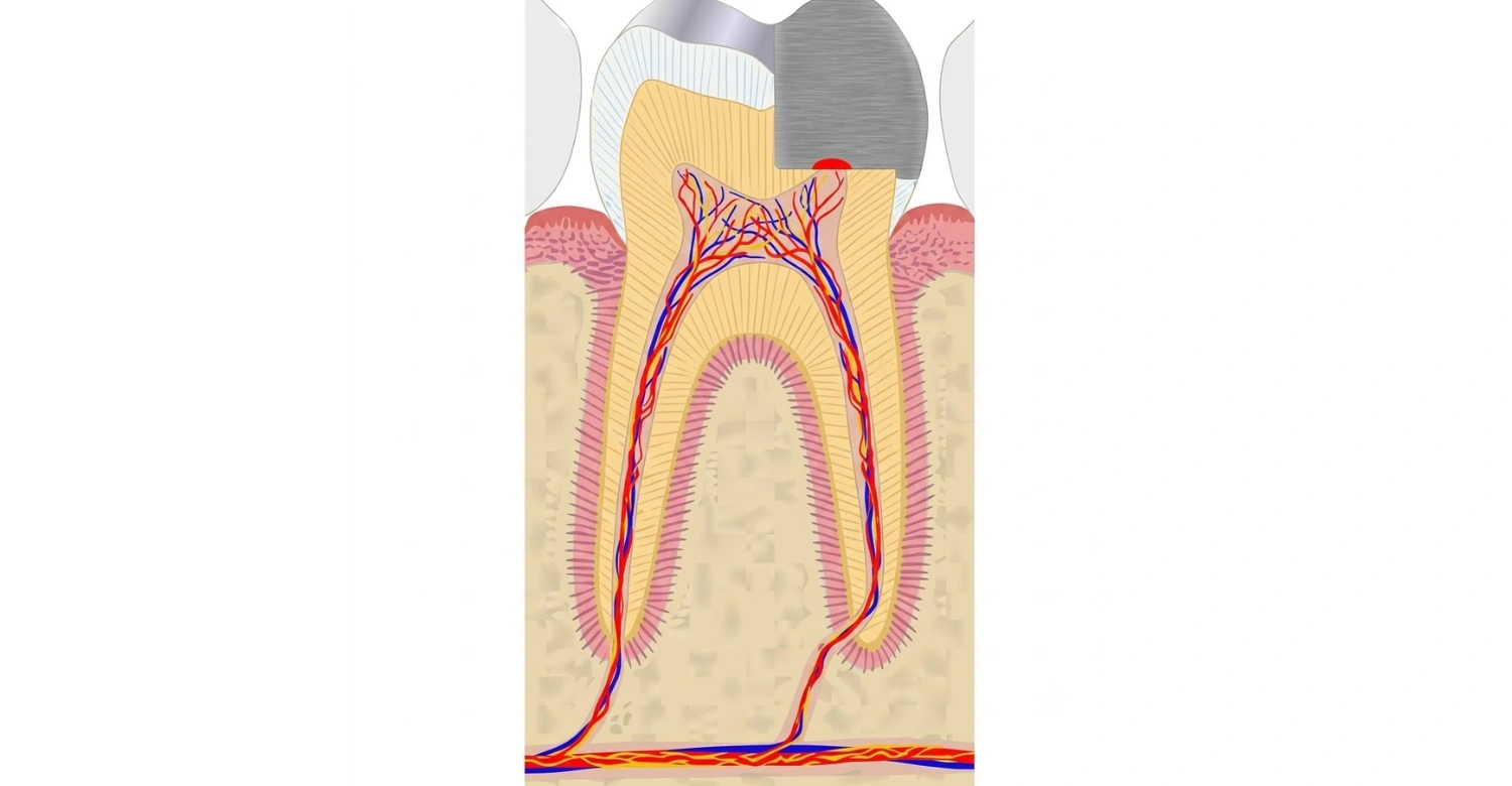 direct pulp capping materials1
